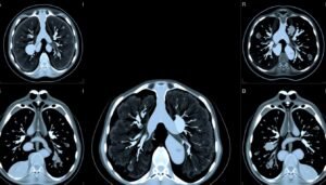 Understanding CT Scan Images of Lung Cancer – careyourlungs