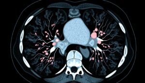 small cell lung cancer ct scan